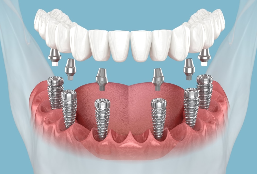 What is the All on 6 Dental Implants? Check If You Are Suitable Candidate.