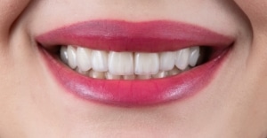 Are Emax Veneers Stronger Than Other Veneers? Durability Facts Dental Harmony Turkey
