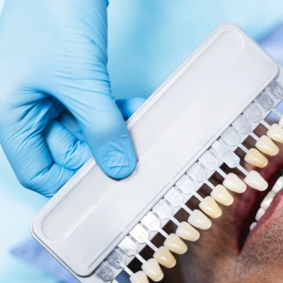How Zirconia Veneers Transform Your Teeth