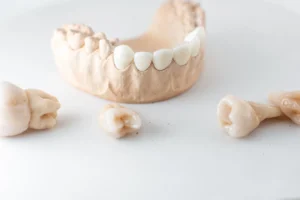Understanding the All-on-4 Dental Implant System