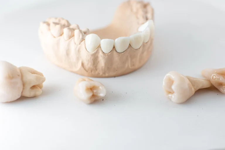 Understanding the All-on-4 Dental Implant System