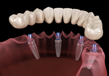 Benefits of All-on-Four Dental Implants