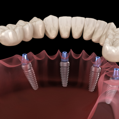 Benefits of All-on-Four Dental Implants