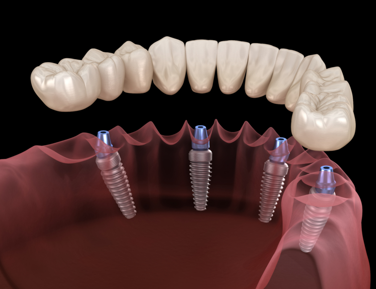 Benefits of All-on-Four Dental Implants