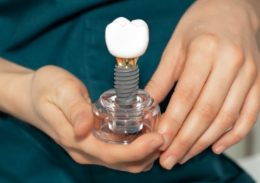 The Procedure: Getting an Implant Bridge