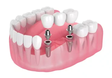 Comparing Implant Bridges