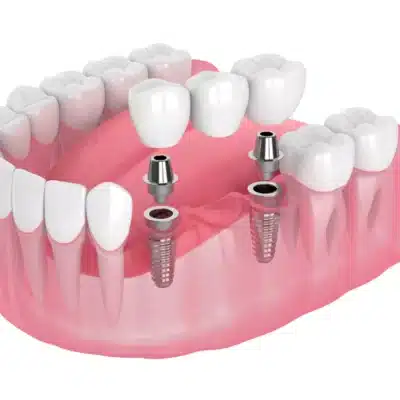 Comparing Implant Bridges