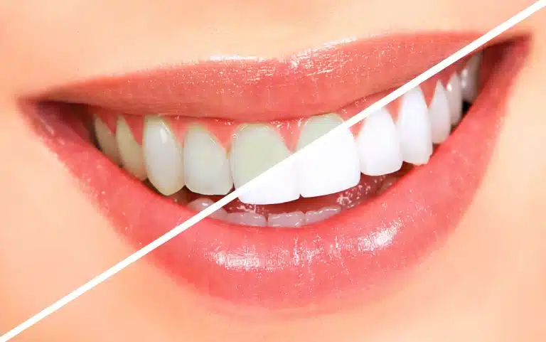 How to Get Rid of White Spots on Teeth- Professional Solutions Dental Harmony Turkey Blog