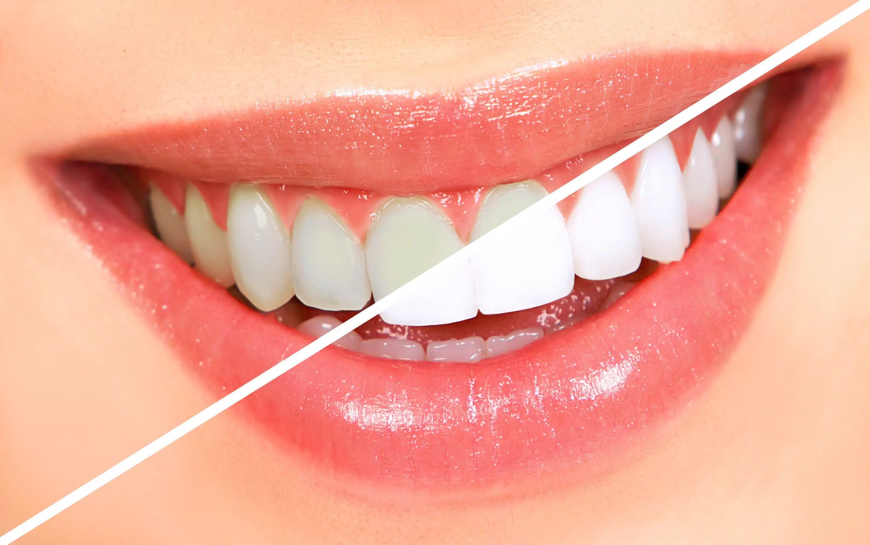 How to Get Rid of White Spots on Teeth- Professional Solutions Dental Harmony Turkey Blog