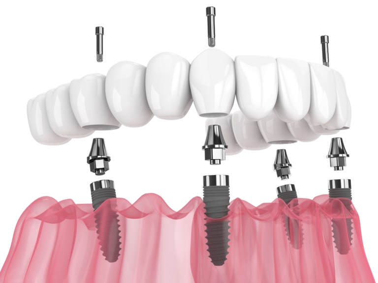 Cost Considerations for All-on-4 Dental Solutions
